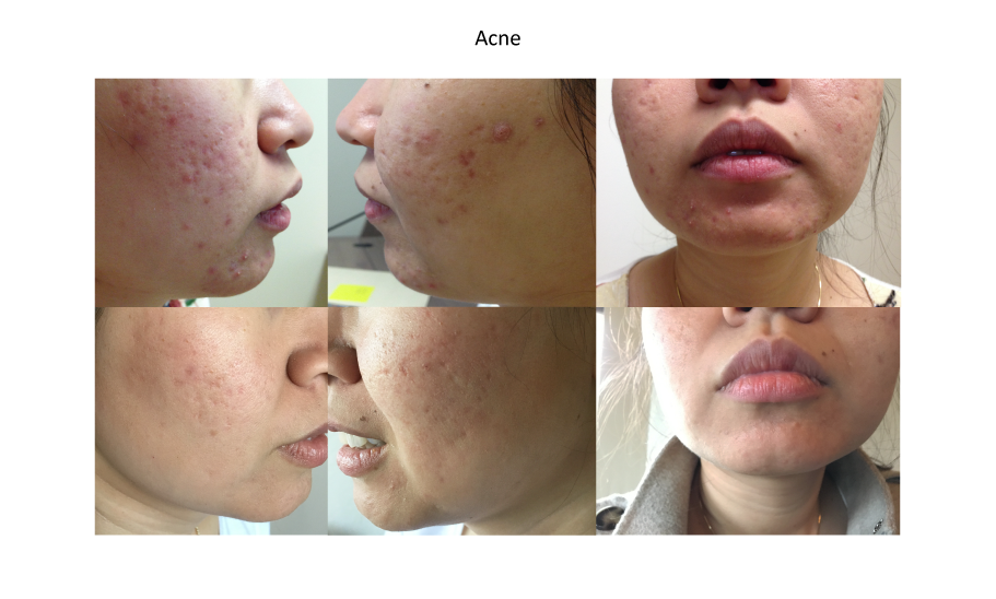 Acne before and after.