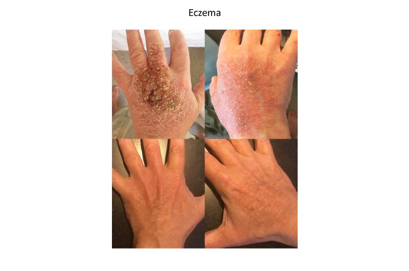 Hand eczema before and after.