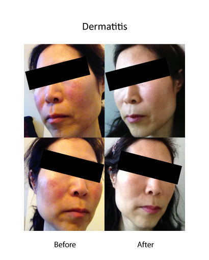 Dermatitis before and after.