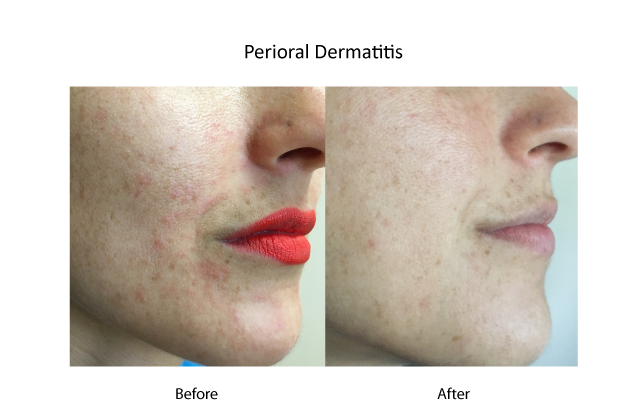 Perioral dermatitis before and after.