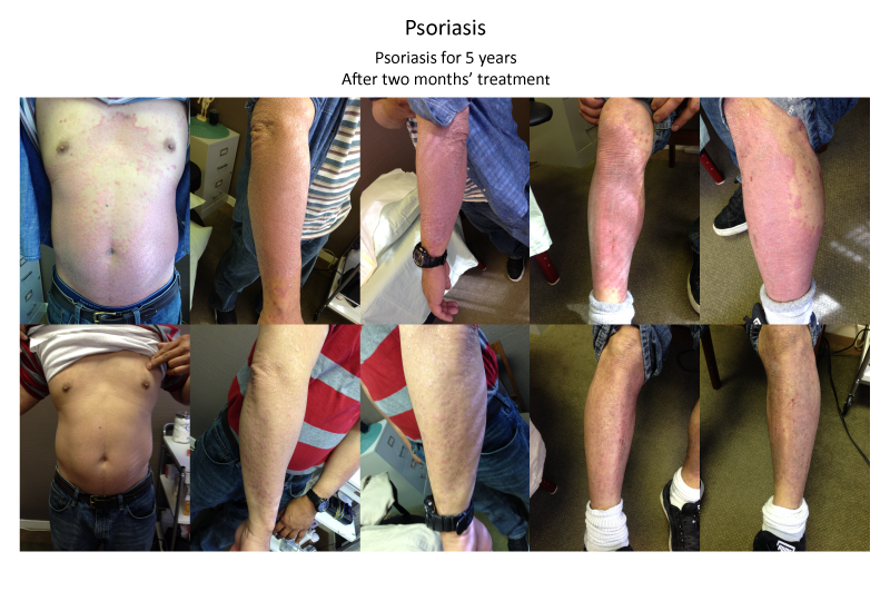 Psoriasis before and after.